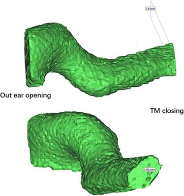 Treatment of congenital middle ear cholesteatoma in children using endoscopic and microscopic ear surgeries: a case series